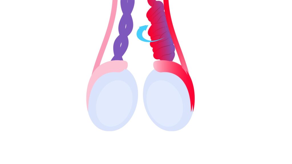 Varicocele treatment cost in Delhi, India