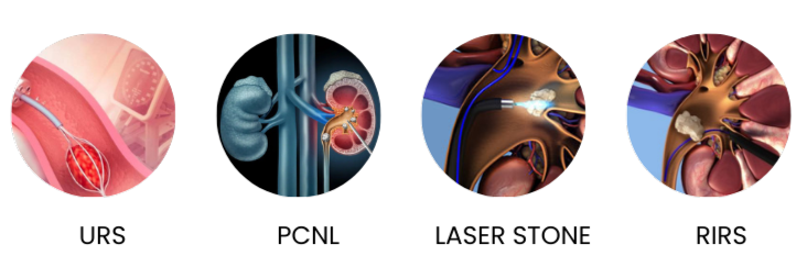kidney stone laser treatment in delhi