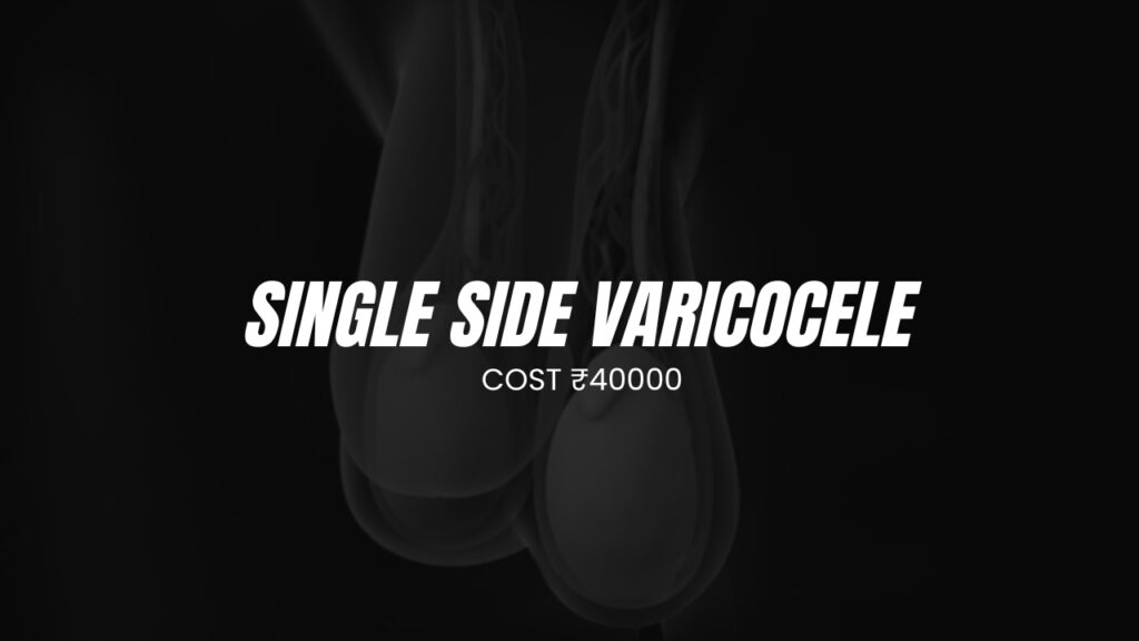 Single Side Varicocele surgery cost